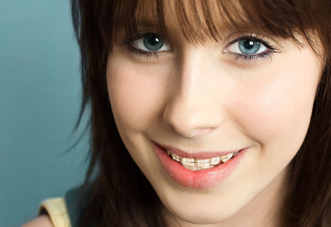 Clear/Ceramic Braces in Milwaukee, WI, Beloit, WI and Roscoe, IL
