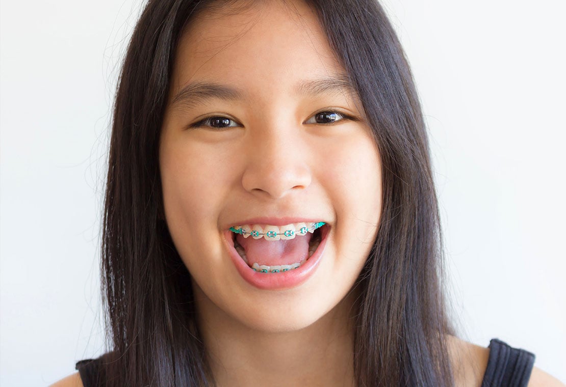(Un)Traditional Braces in Milwaukee, WI, Beloit, WI and Roscoe, IL